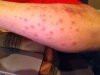 ant bites.JPG ant bites.JPG
